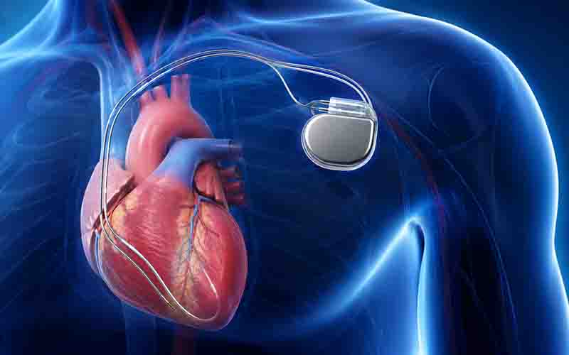 CRT Implantation