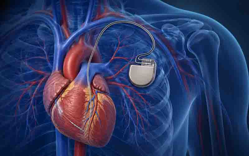ICD Implantation