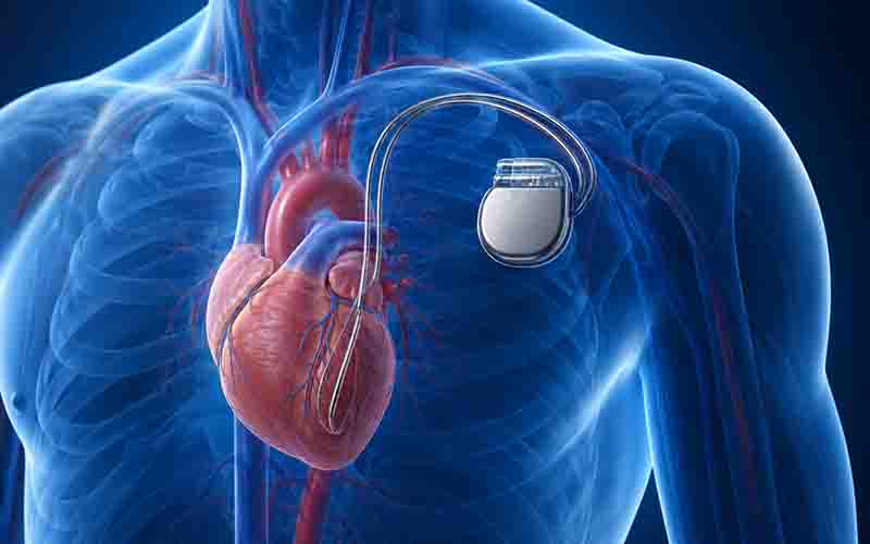 Pacemaker Implantation